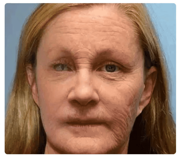 Botox Bee Venom