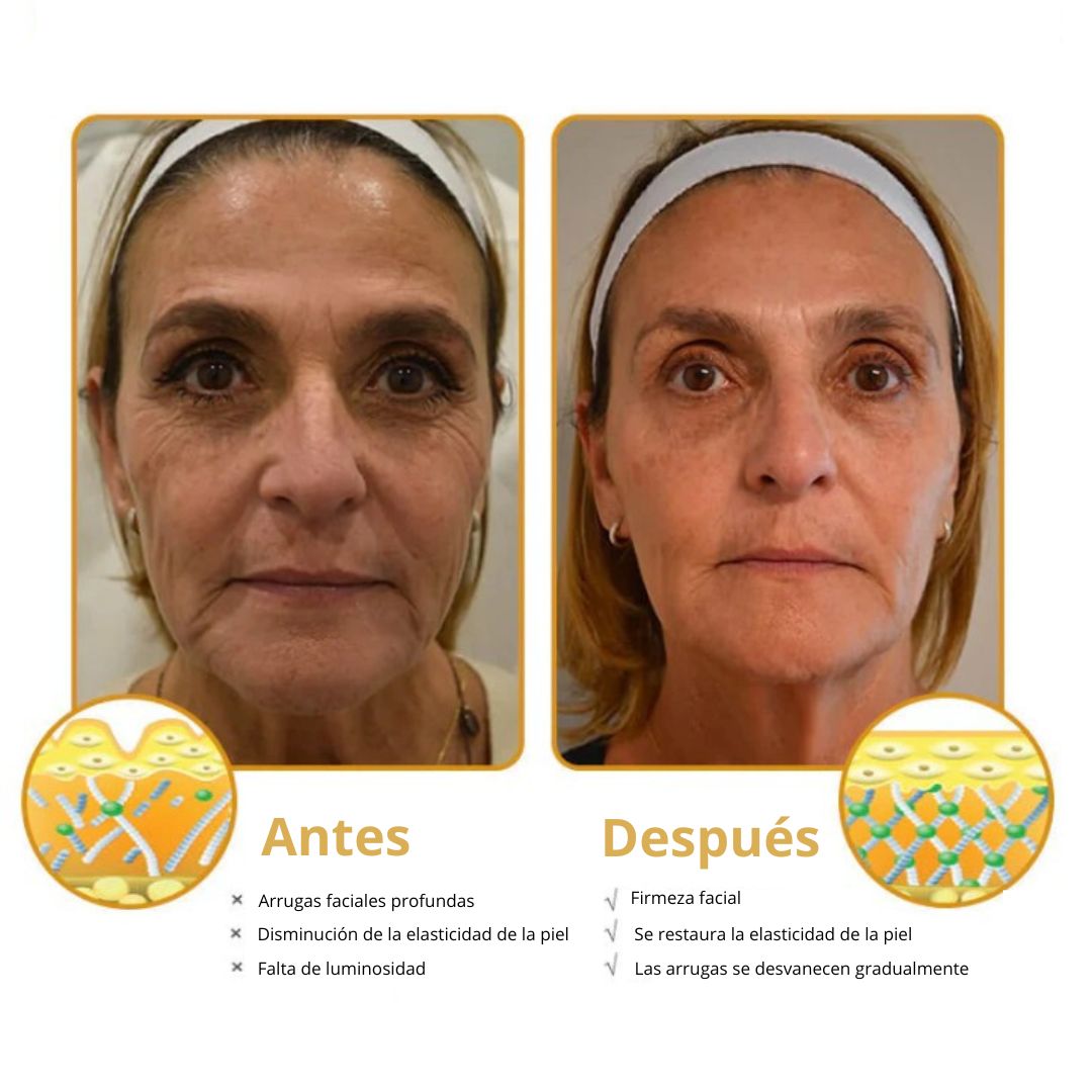Botox Bee Venom